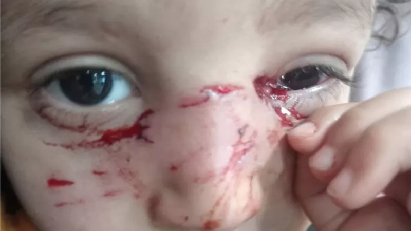 إصابات خطيرة بالوجه والعين.. كلب ضال يهاجم طفلاً في مدينة السويس 