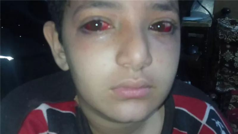 مطالبات بمحاسبة المسؤولين بعد إصابة طالب فى عينه نتيجة اعتداء داخل مدرسة