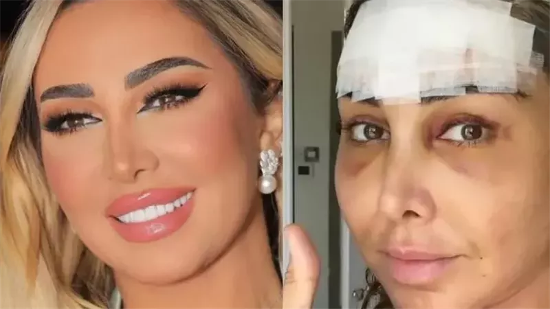 جويل ماردينيان تعيد تسليط الضوء على عمليتها لشد الوجه 