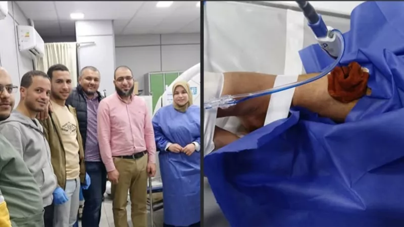 إنجاز طبي جديد بجامعة بني سويف في علاج أورام العظام بالكي الحراري