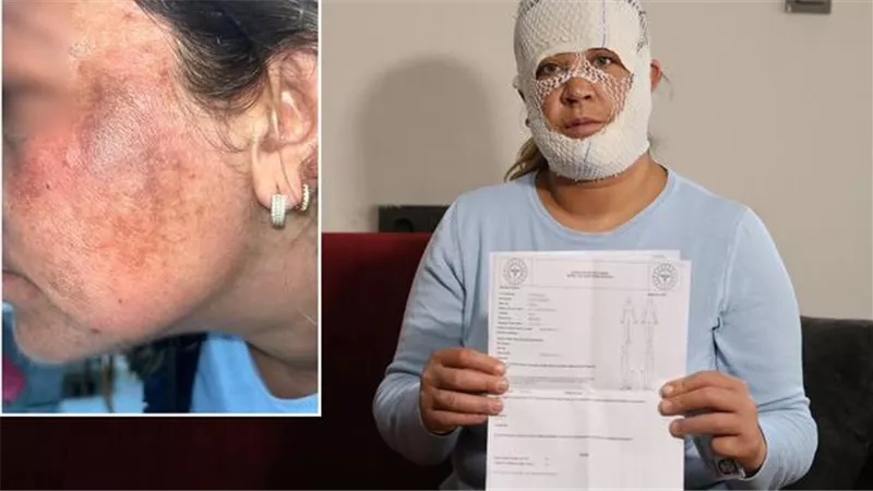 من علاج الأميرات لحروق بالغة.. تركية تخسر وجهها في مركز تجميل
