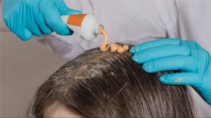 هل تقلل زيوت الشعر من قشرة الشعر؟ خبيرة تجيب|خاص.. اليكي التفاصيل 