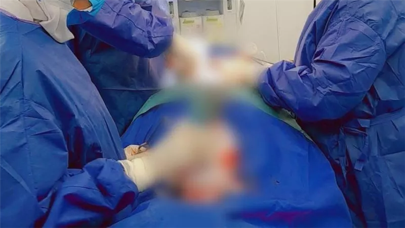 نجاح جراحة دقيقة لتثبيت فقرات العمود الفقري لفتاة بمستشفى القنطرة غرب المركزي