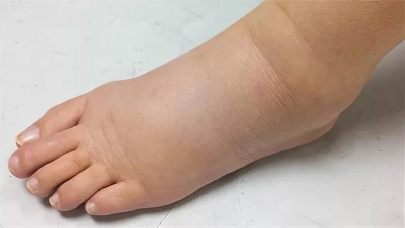 احتباس الماء في الجسم.. 7 طرق فعالة للتخلص من السوائل الزائدة 