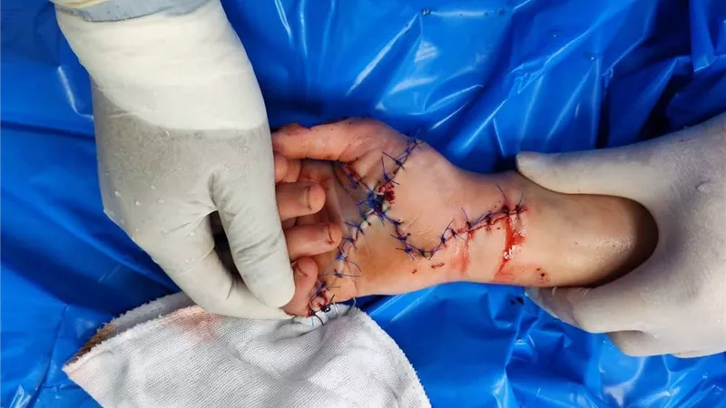 «إنجاز طبي بسوهاج».. فريق جامعي ينقذ حياة فتاة ويدها من البتر الكامل 