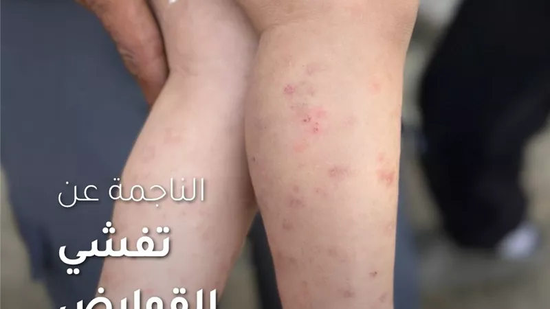 الفئران تنهش أطفال غزة داخل الخيام وأونروا تحذر من انهيار صحي 
