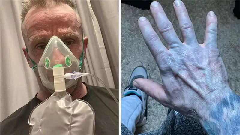 حالة غريبة في الطوارئ.. رجل يتحول لـ الأزرق بسبب ملاءات السرير