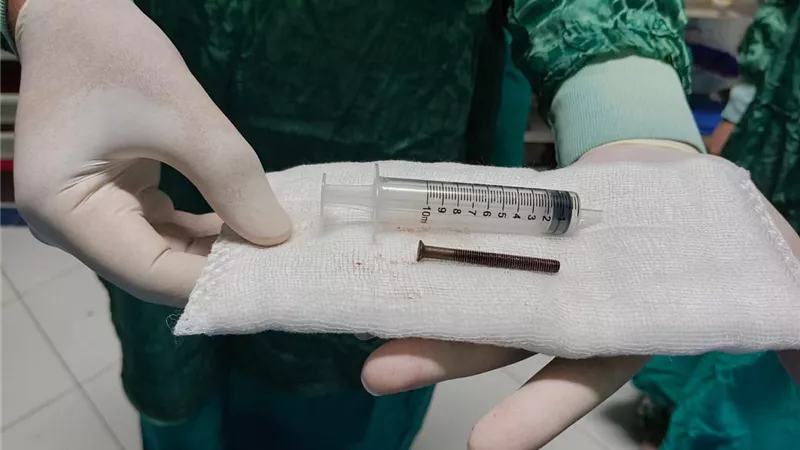 إنقاذ طفلة ابتلعت «مسمارًا» بطول 10 سم داخل مستشفيات جامعة الزقازيق