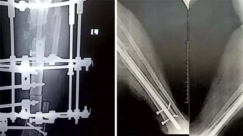 نجاح جراحة نادرة لإعادة بناء عظمة ساق مريضة داخل الكرنك الدولي بالأقصر