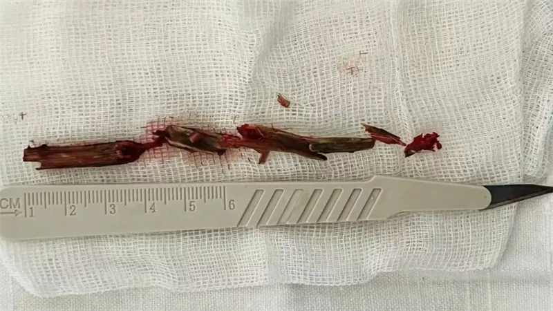  دون علمه|رجل يعيش مع غصن خشبي طوله 5 بوصات في تجويف عينه