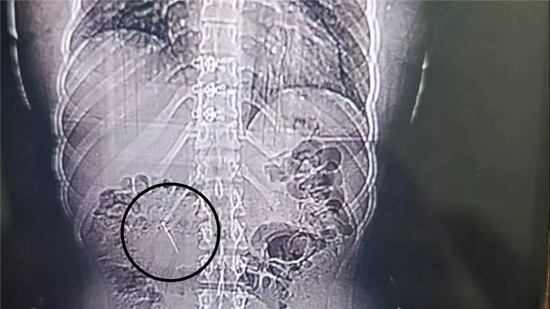 إنقاذ فتاة بعد ابتلاعها دبوسا معدنيا بطول 4 سم ببورسعيد