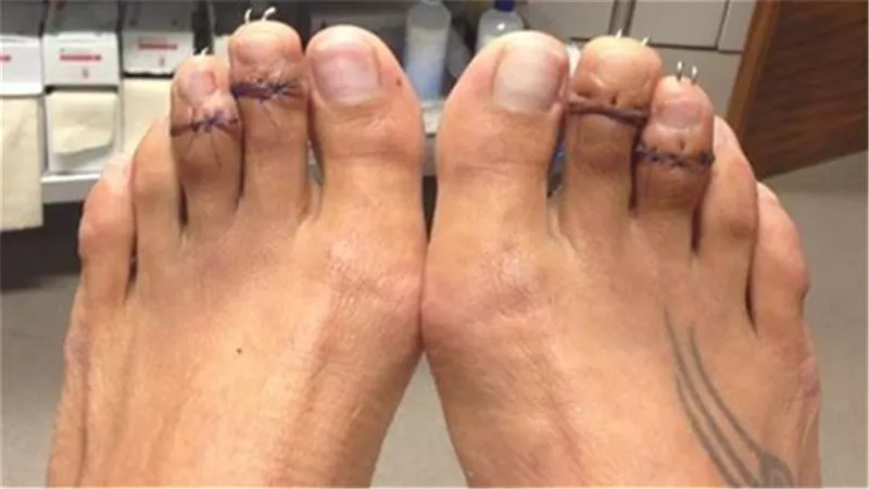 ظاهرة جديدة في عالم التجميل هذا الصيف.. عملية تقصير أصابع القدم 