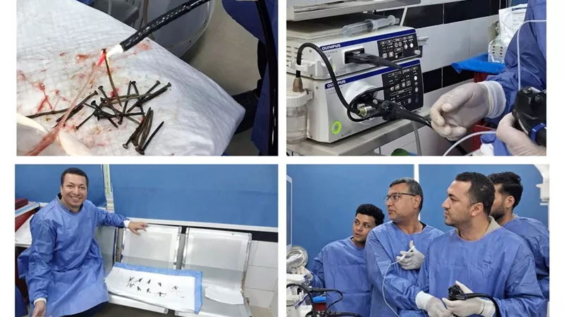 استخراج 100 مسمار وصامولة من معدة مريض بدون تدخل جراحي ببني سويف الجامعي