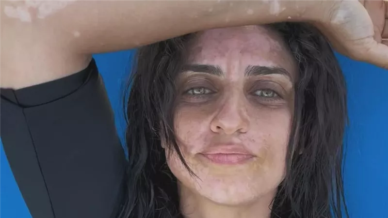 شقيقة أمير كرارة بعد تصدرها التريند لإصابتها بالبهاق : بقالي 3 سنين