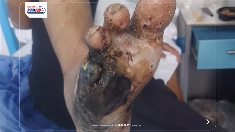استغاثة مريض قدم سكري بالفيوم: أجريت كل الإجراءات والجراحة تتأجل للمرة الثانية