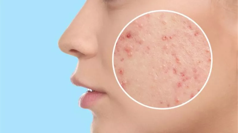 ليس بسبب قلة النظافة.. ما الذي يسبب حب الشباب وكيف يمكن علاجه؟
