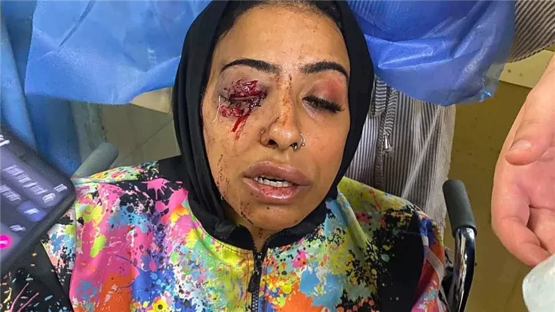 استغاثة عاجلة لإنقاذ موظفة بدمياط بعد إصابتها في اعتداء أفقدها عينها اليمنى