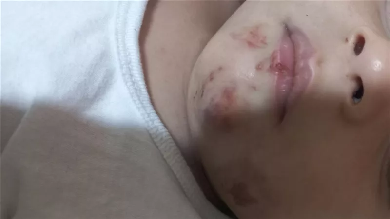 «أصعب تجربة في حياتي».. أم تكشف إصابة طفلها داخل حضانة 