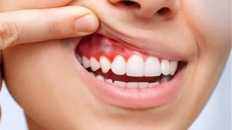 تشعر بطعم الدم في فمك؟.. أسباب غير متوقعة قد تكون وراء الأمر
