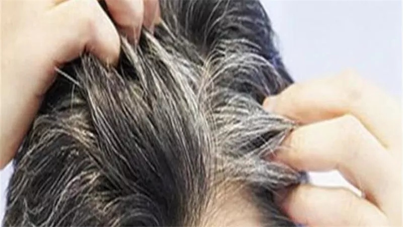 الشيب عند الرجال.. متى يبدأ وما أسباب ظهوره المبكر؟ 