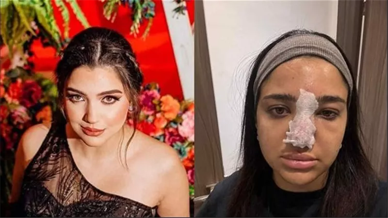 بعد عام من تشوه أنفها.. كنزي مدبولي: 