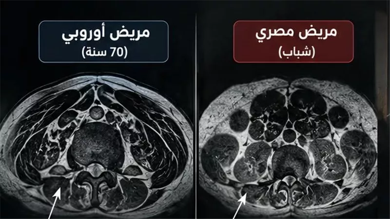 العضلات بتختفي.. دراسة تكشف مخاطر قلة الحركة وسوء التغذية عند المصريين 