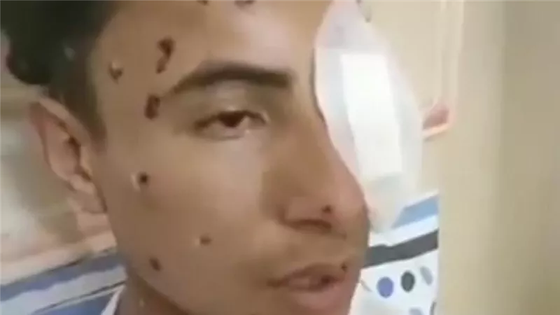  «كان بيجري على أكل عيشه».. حكاية شاب من بورسعيد فقد عينه في لحظة 
