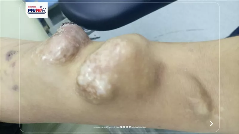 مستشفى الفكرية بالمنيا ينقذ حياة شاب في جراحة عاجلة لإصلاح تمدد منفجر بوصلة الغسيل الكلوي