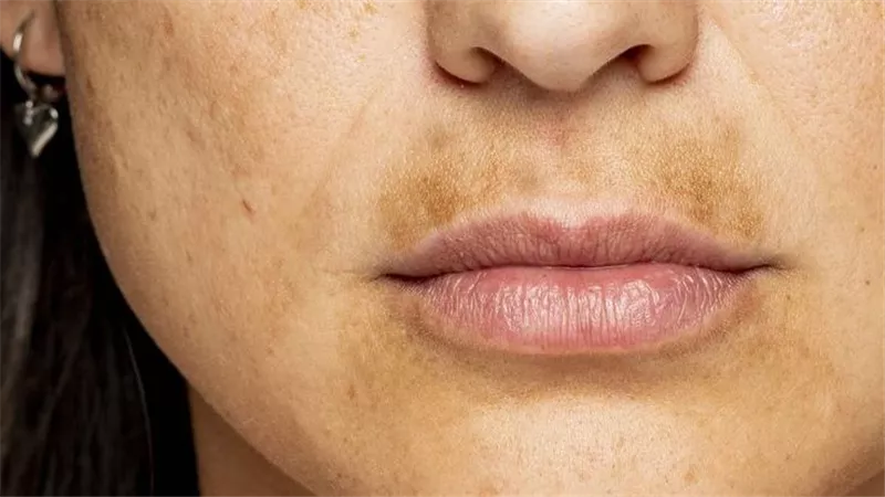 كيفية التخلص من الكلف حول الفم.. دليلكِ لاستعادة إشراقة بشرتكِ